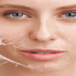 Peeling de fenol