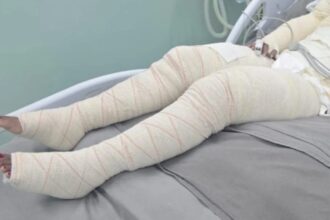 Vítima teve queimaduras graves em diversas partes do corpo e encontra-se internada
